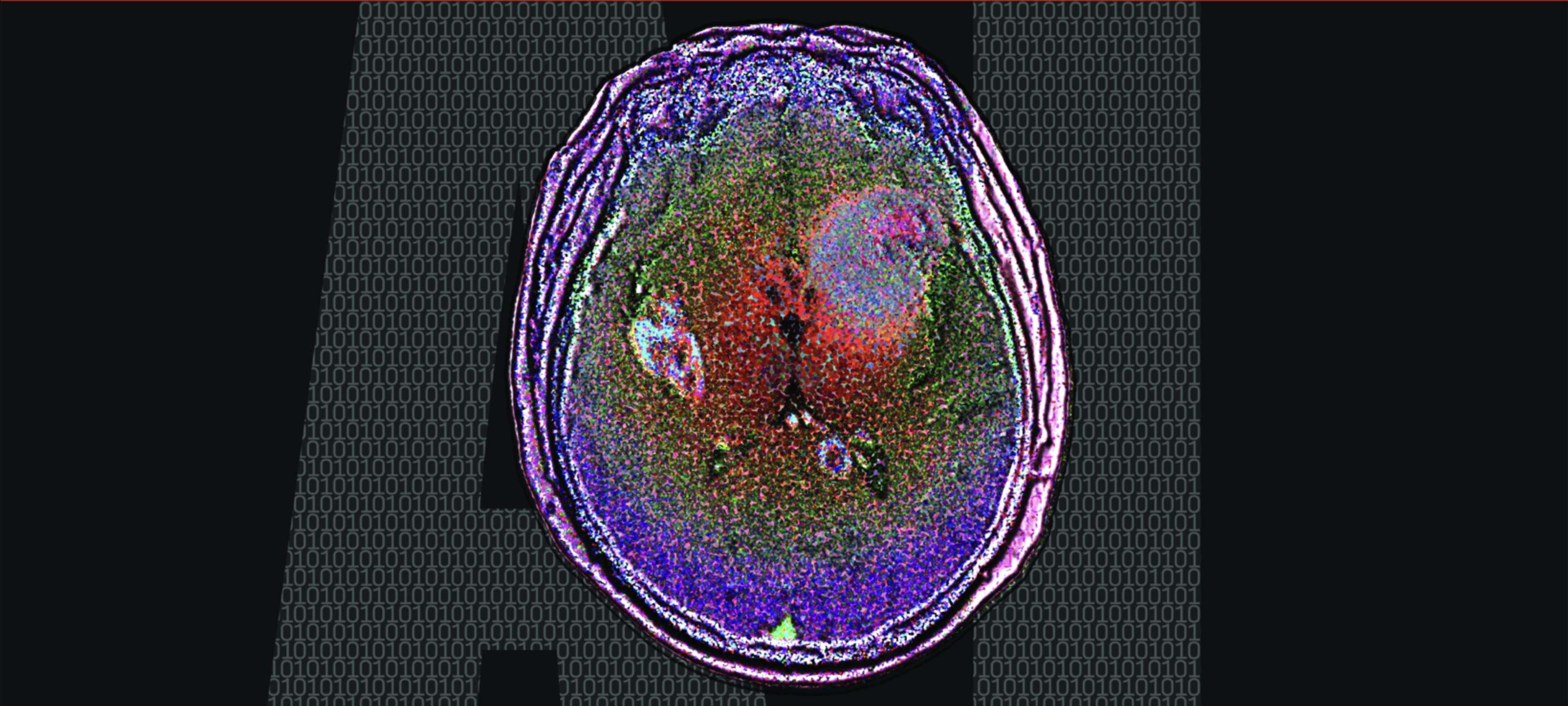 A Rare Case of Sweat Gland Carcinoma of the Breast